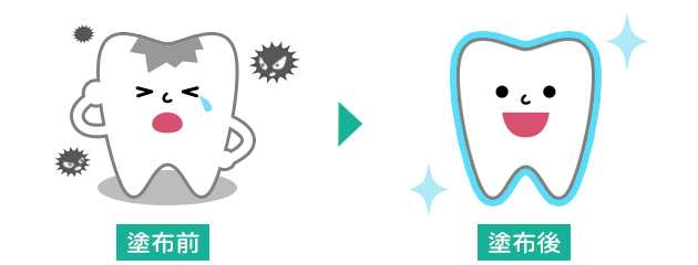 フッ素塗布の施術前後の状態